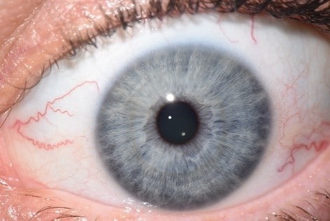Lymphatic Eyes | Iridology Assessments by Peppy | What do your eyes say about you?