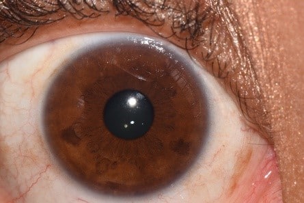 Hematogenic Eyes | Iridology Assessments by Peppy | What do your eyes say about you?
