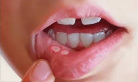 mouth ulcers and Juice Plus